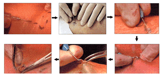 보행정맥 절제술 시술과정