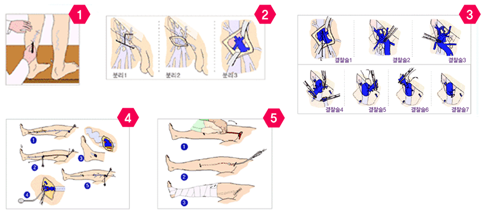 고위 결찰법 및 스트리핑 시술과정
